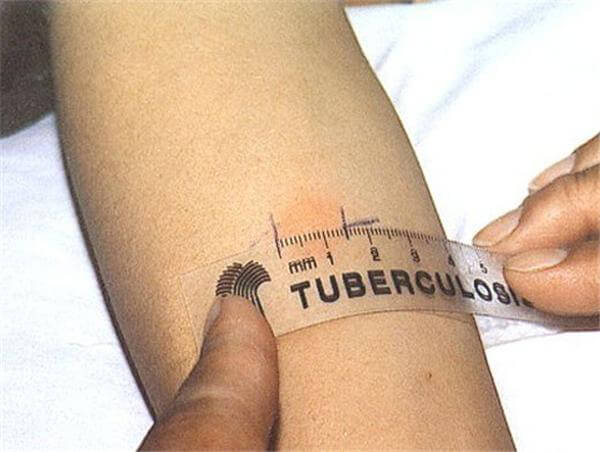 фото По требованию прокуратуры нелидовцы направлены на принудительное лечение от туберкулеза